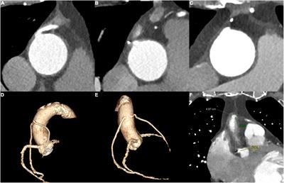 Coronary CTA Would Facilitate Invasive Angiography in Patients With Acute Coronary Syndrome and Coronary Bypass Grafting History